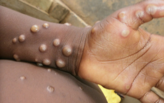Monkeypox: le Royaume-Uni confirme quatre nouveaux cas chez les hommes homosexuels et bisexuels