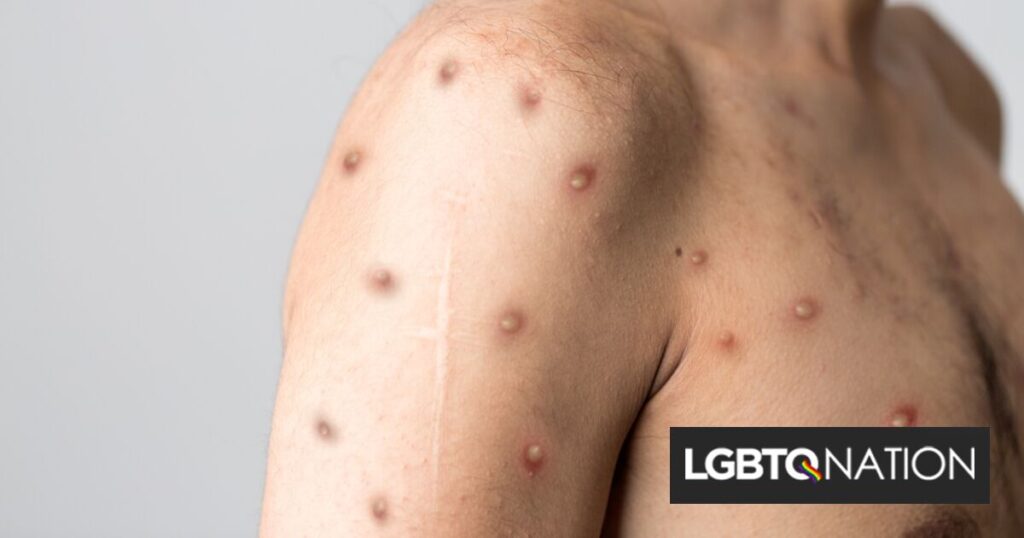 L’administration Biden distribuera plus d’un million de vaccins pour lutter contre l’épidémie de monkeypox L'administration Biden distribuera plus d'un million de vaccins pour lutter contre l'épidémie de monkeypox