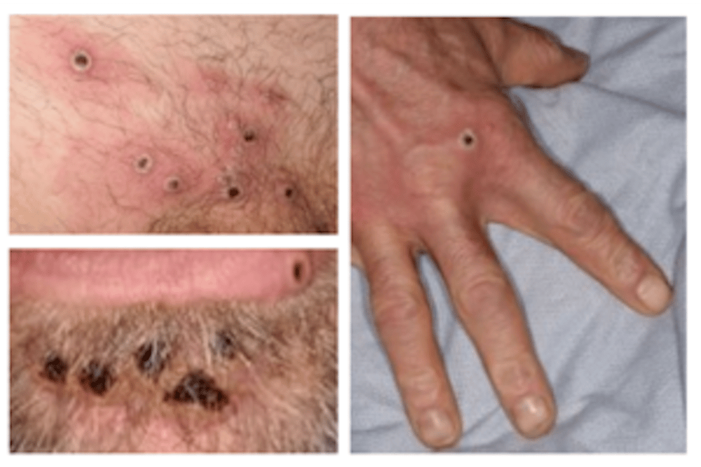 Lésions de monkeypox