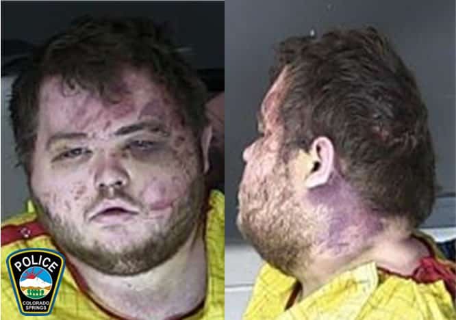 Deux clichés du tireur de Colorado Springs Anderson Lee Aldrich montrant de graves ecchymoses au visage et au cou