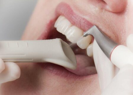 Le détartrage des dents : un acte essentiel pour une bonne santé bucco-dentaire