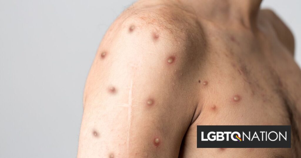 Les cas de Mpox ont doublé dans le comté de Los Angeles au cours des quatre derniers mois Les cas de Mpox ont doublé dans le comté de Los Angeles au cours des quatre derniers mois