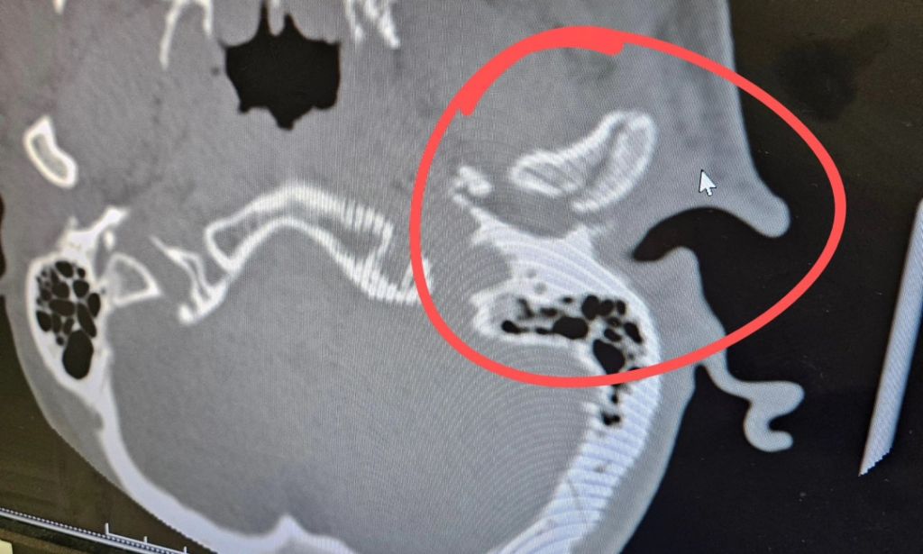Un scanner avec un anneau rouge autour d'une fracture osseuse.