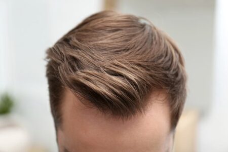 Comprendre la greffe de cheveux pour faire un choix éclairé